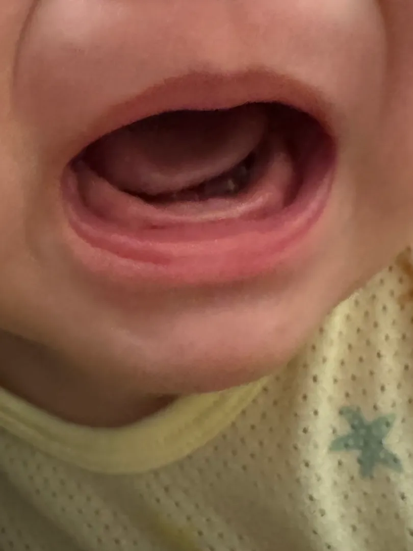 이앓이 일까요?ㅠ