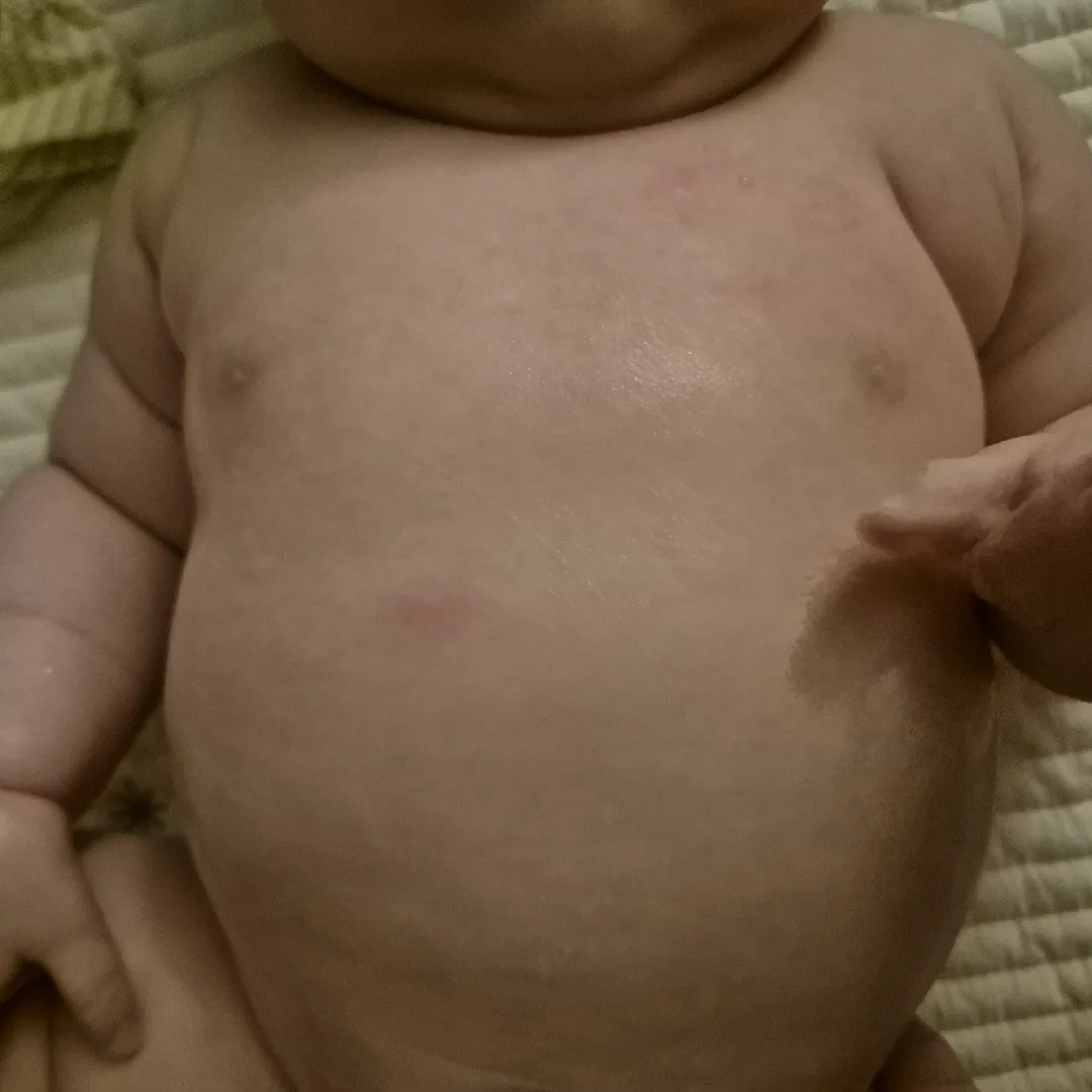 완모에서 혼합으로,, 분유알레르기인가요?