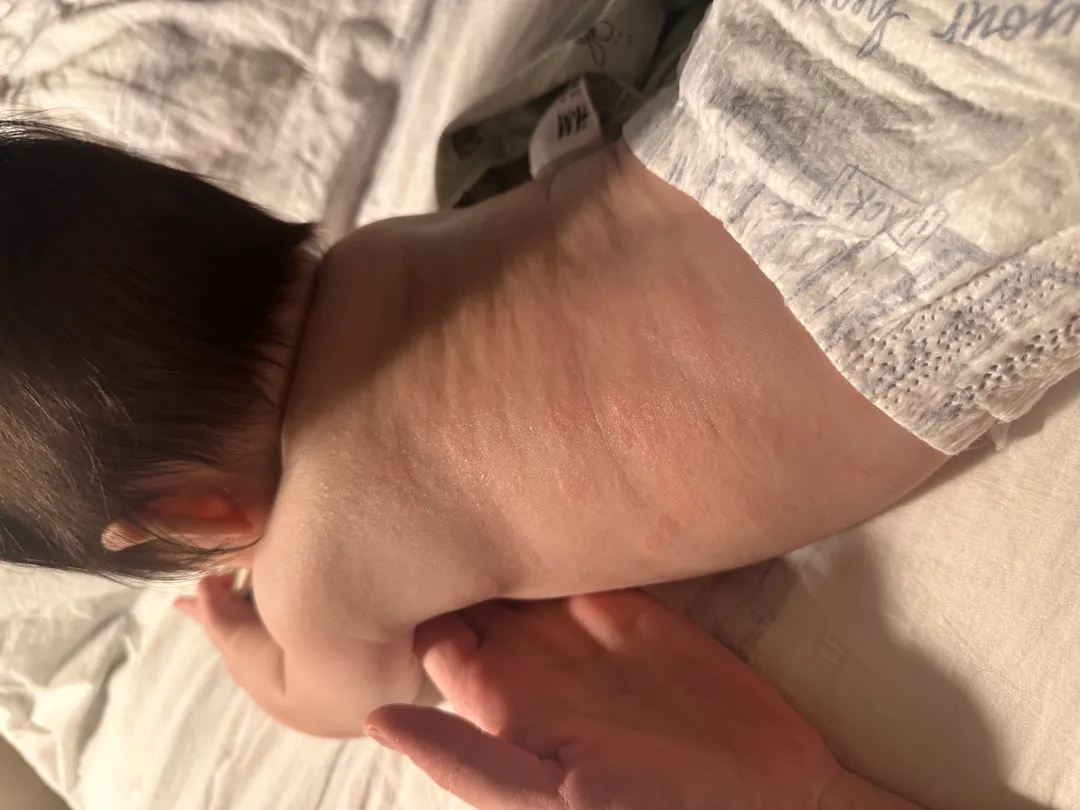 이거… 아토피일까요?