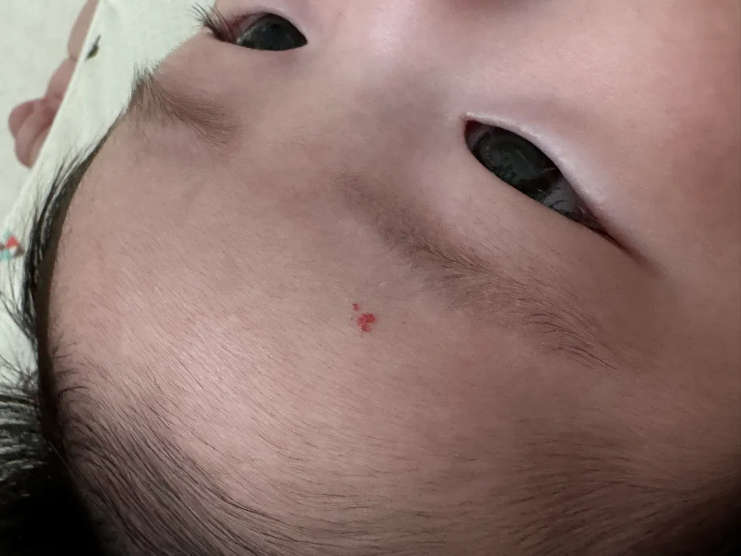 혈관종 봐주세요ㅠㅠ