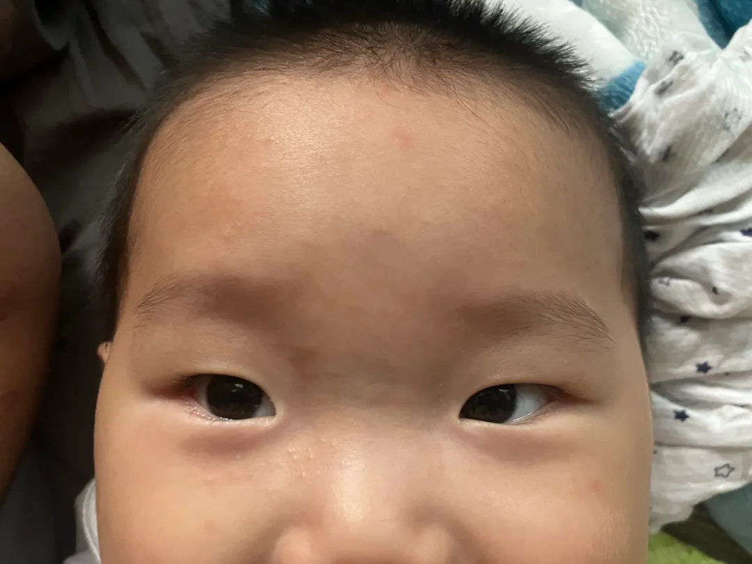 열꽃 수족구