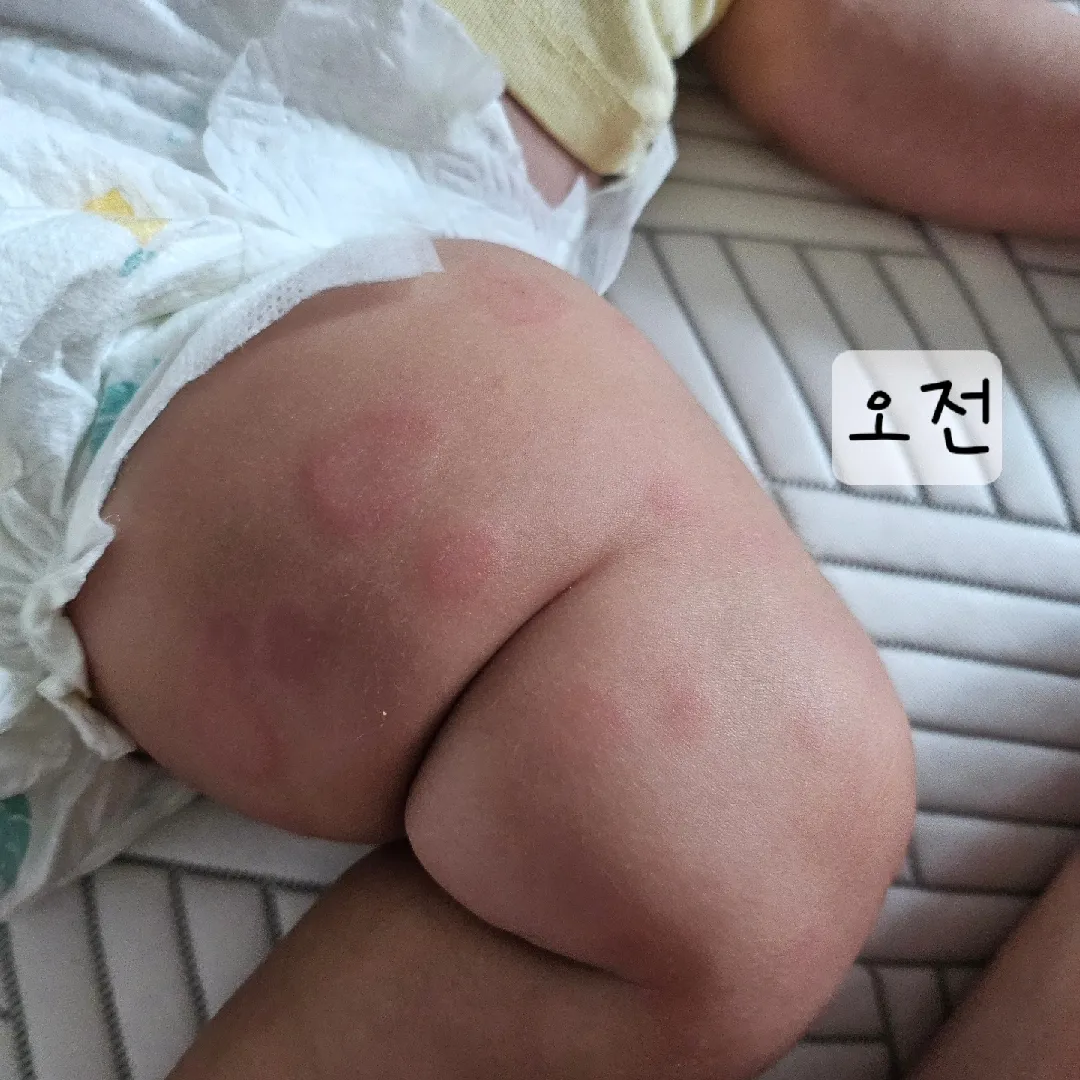 동전습진