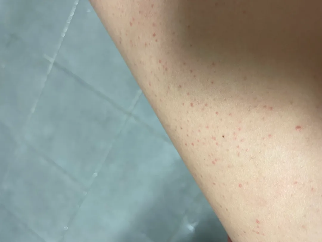 출산후 피부..저같은사람 있나요?