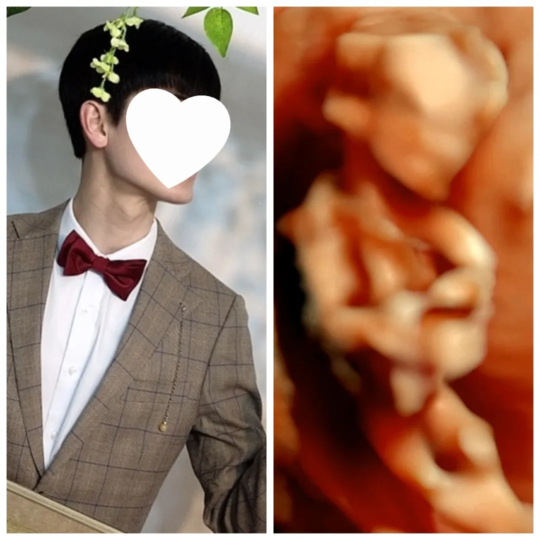 12주 입체초음파인데 왜 벌써 남편얼굴이 보이죠?