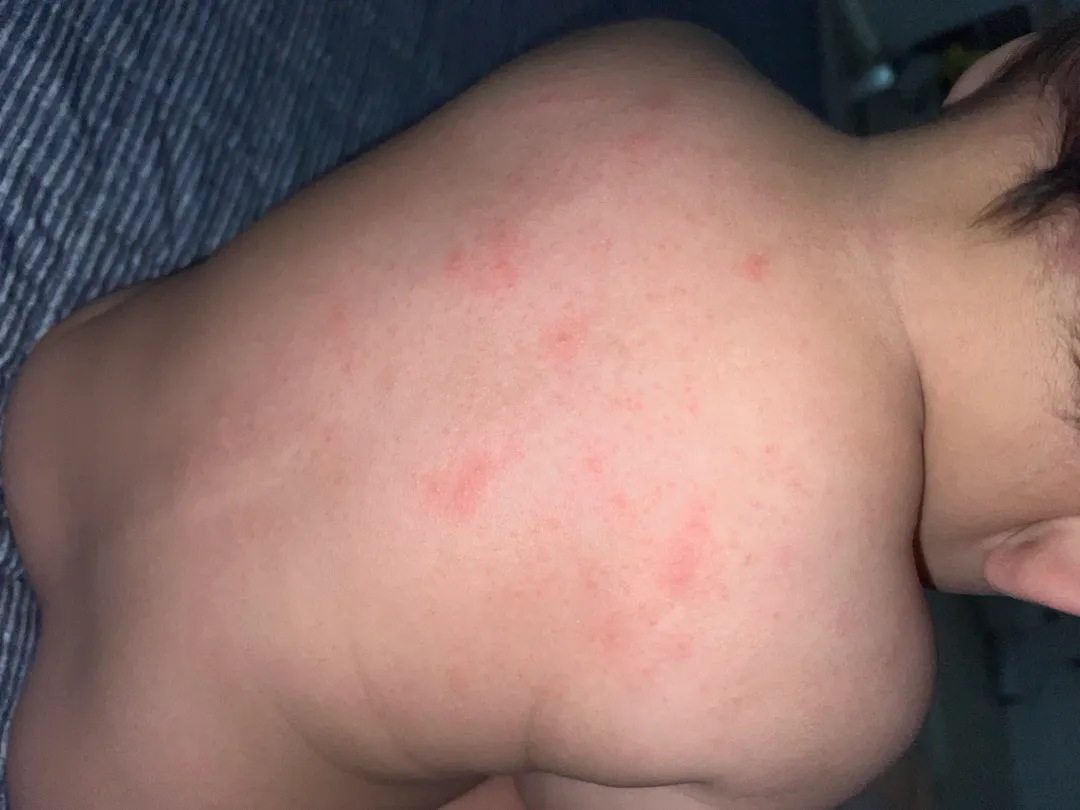 6~7개월 아기 등 두드러기 가려움 어쩌조??