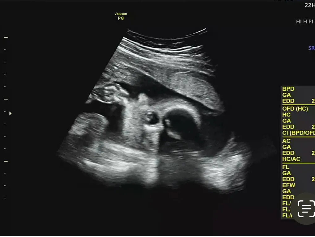 손가락 빠네요🍼(24주)