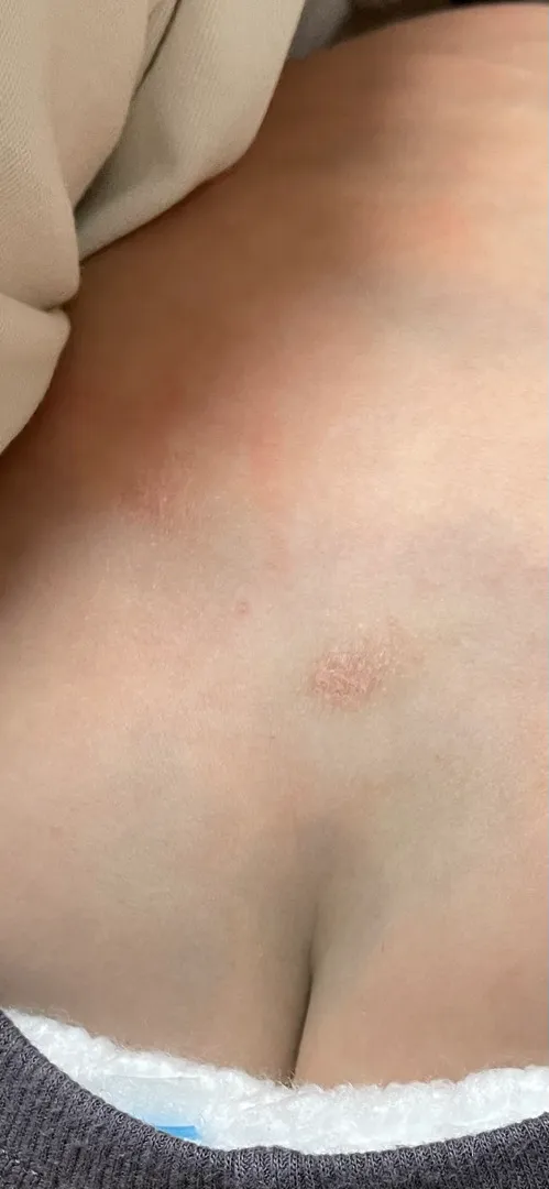 아기 피부좀 봐주세요 ㅠㅜ