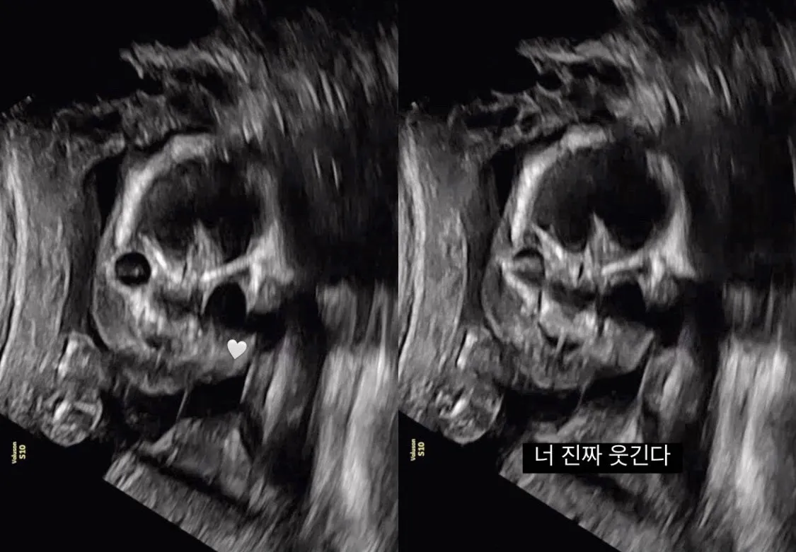 19주 2일, 앞모습 너무 웃겨요 ㅋㅋㅋㅋㅋㅋㅋㅋㅋㅋㅋㅋ