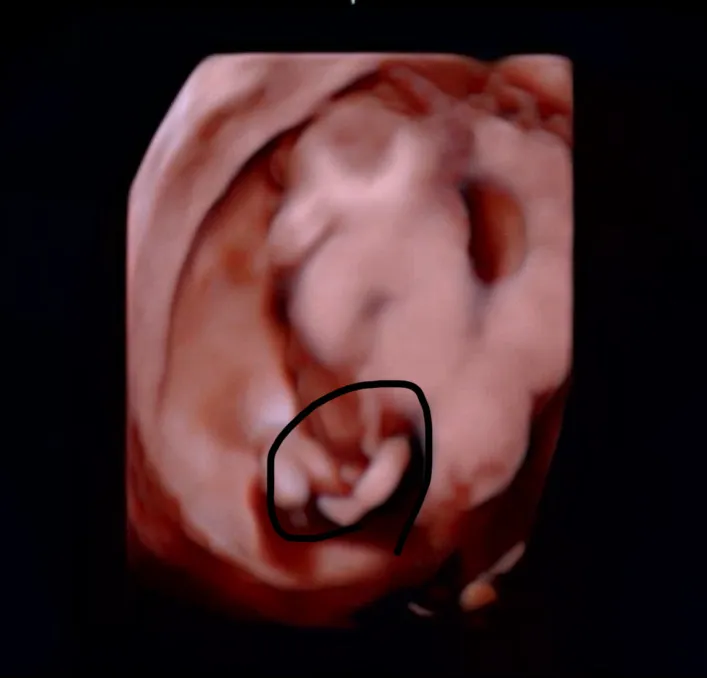 13주 성별 뭘까요??