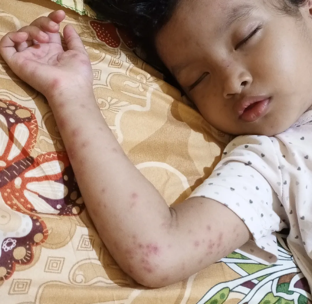 Cacar atau flu Singapur??