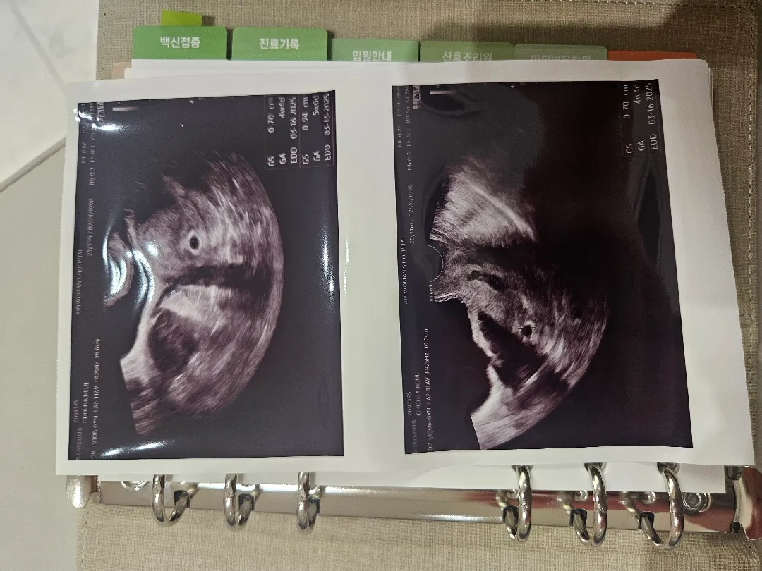 피검수치 너무 낮아서 걱정했는데 아기집 보고왔어요!