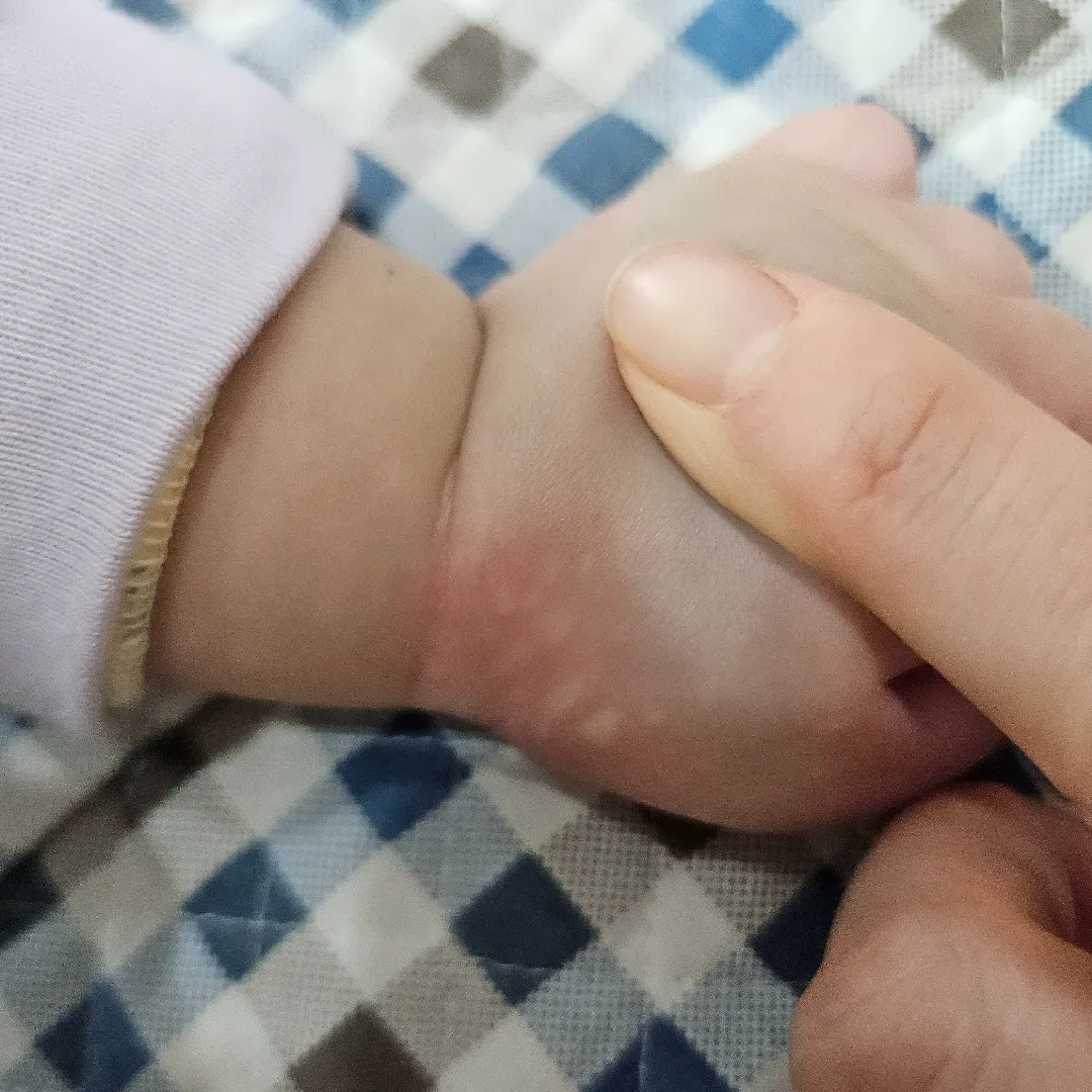 두드러기?
