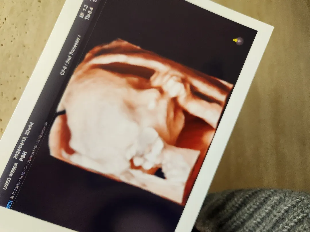 정밀초음파 할 때마다 엎드려 있는 아가ㅠㅠ