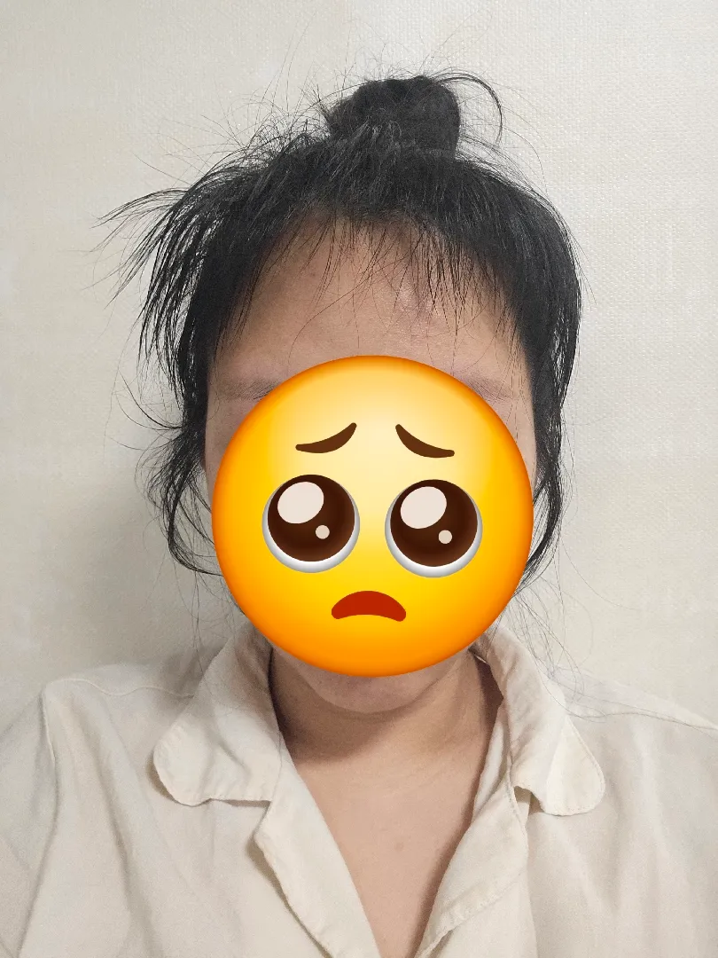 산후탈모 현재도 진행중 ^-^.. 