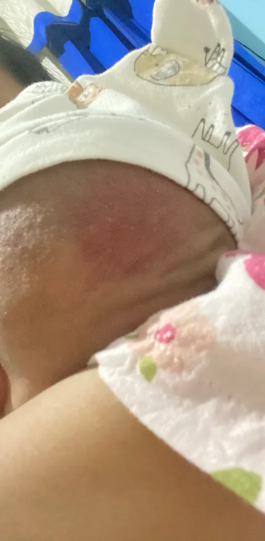 Ruam di kepala bayi