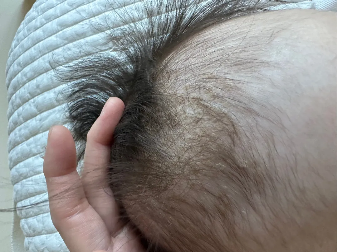 아기 지루성 두피염?