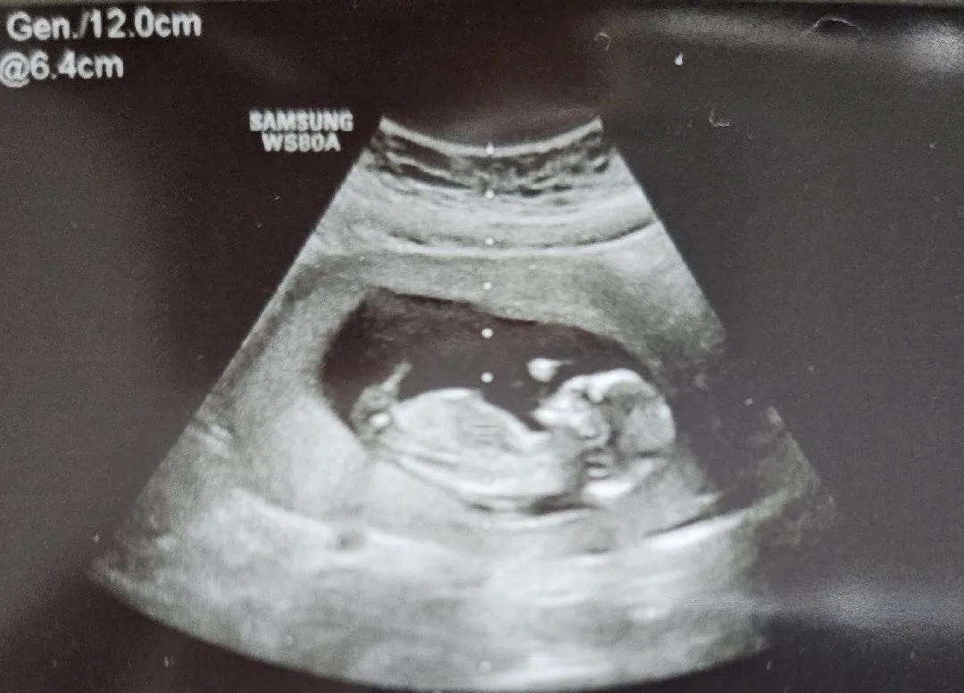 12주5일 성별확인!