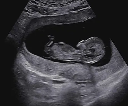 12주 1차 기형아 검사 했어요👶🏻
