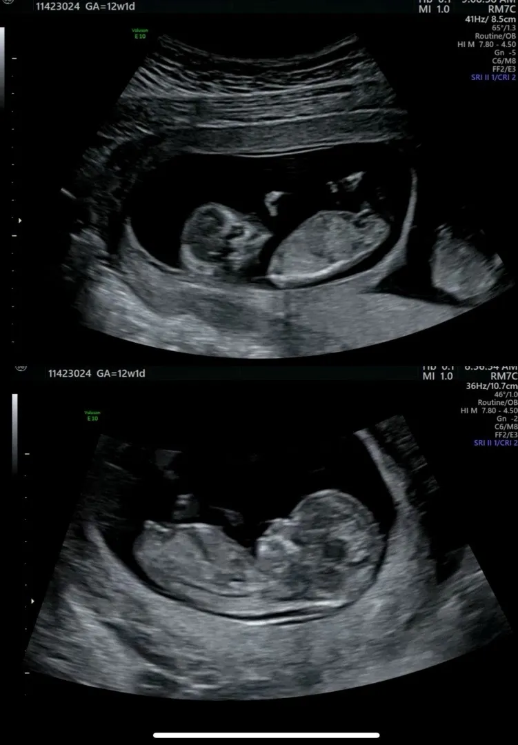 쌍둥이 각도법이요!