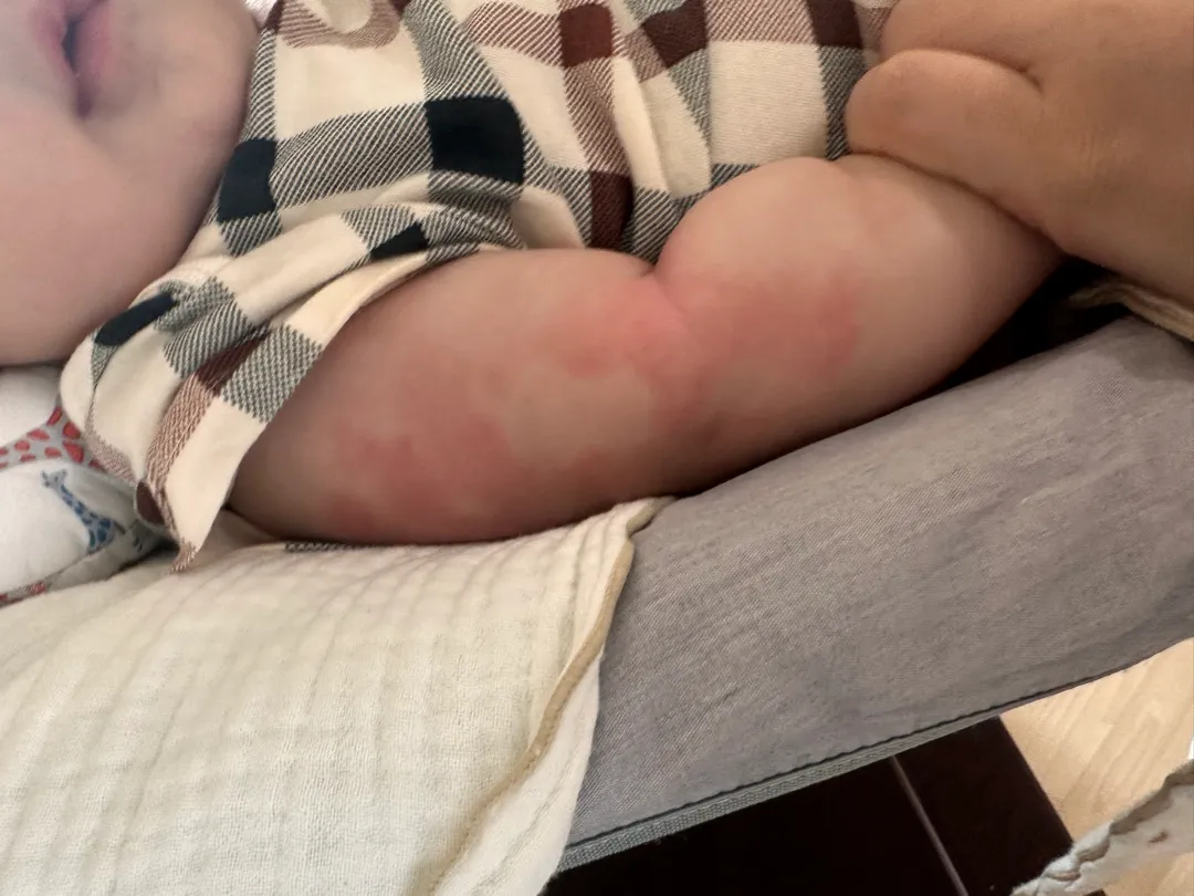 땀띠 일까요?