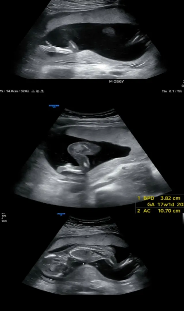 16주1일차에 2차기형아검진👶🏻
