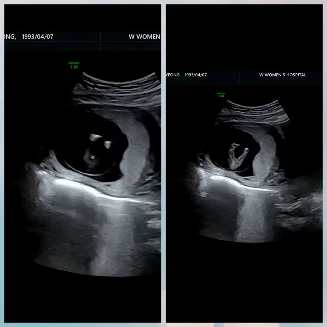 12주2일 다리사이 초음파 아들?딸?