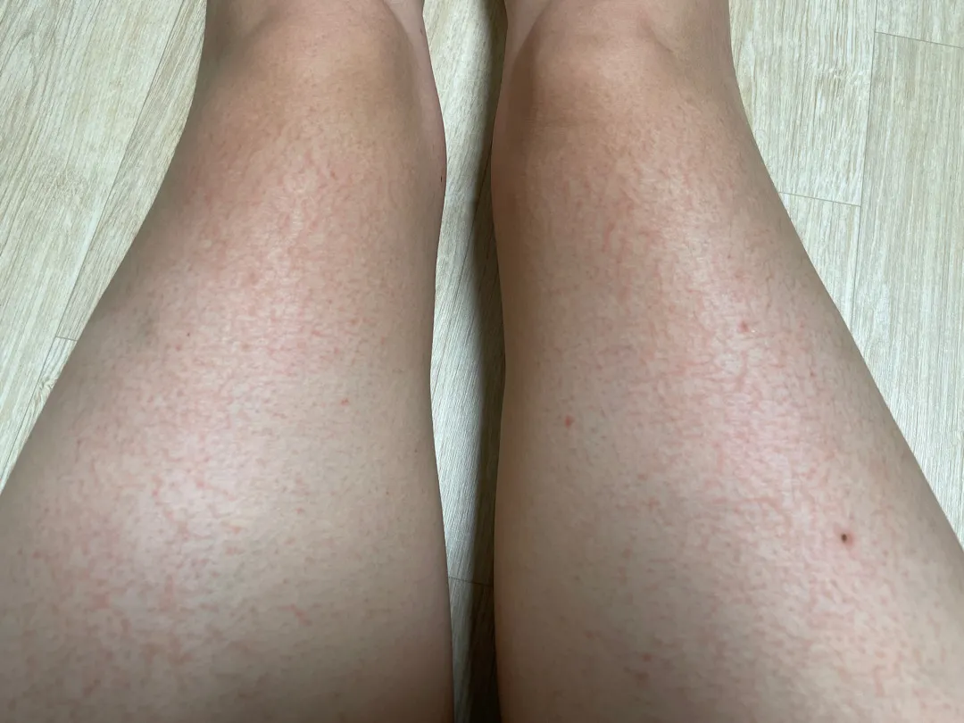 겨울철 피부관리 어뜩케하나요??