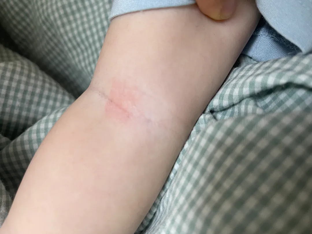 팔꿈치 안쪽이 빨간데..아토피는 아닌가 걱정되네용ㅠㅠ