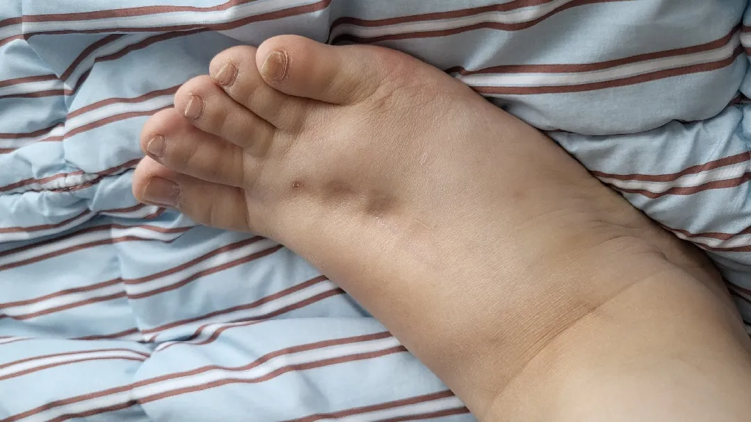 부종 ㅠㅠ