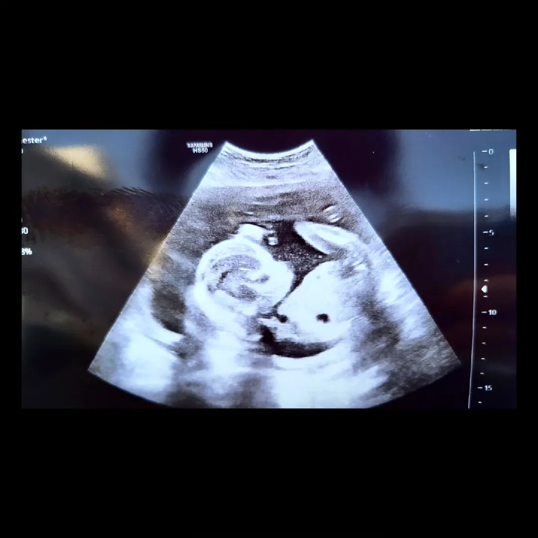 19주 ♡ 모양 심장