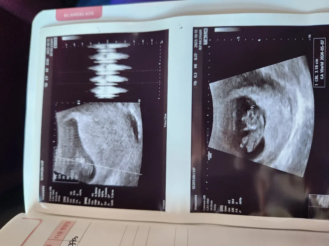 9주4일차 초음파 보고 왔어용 👶