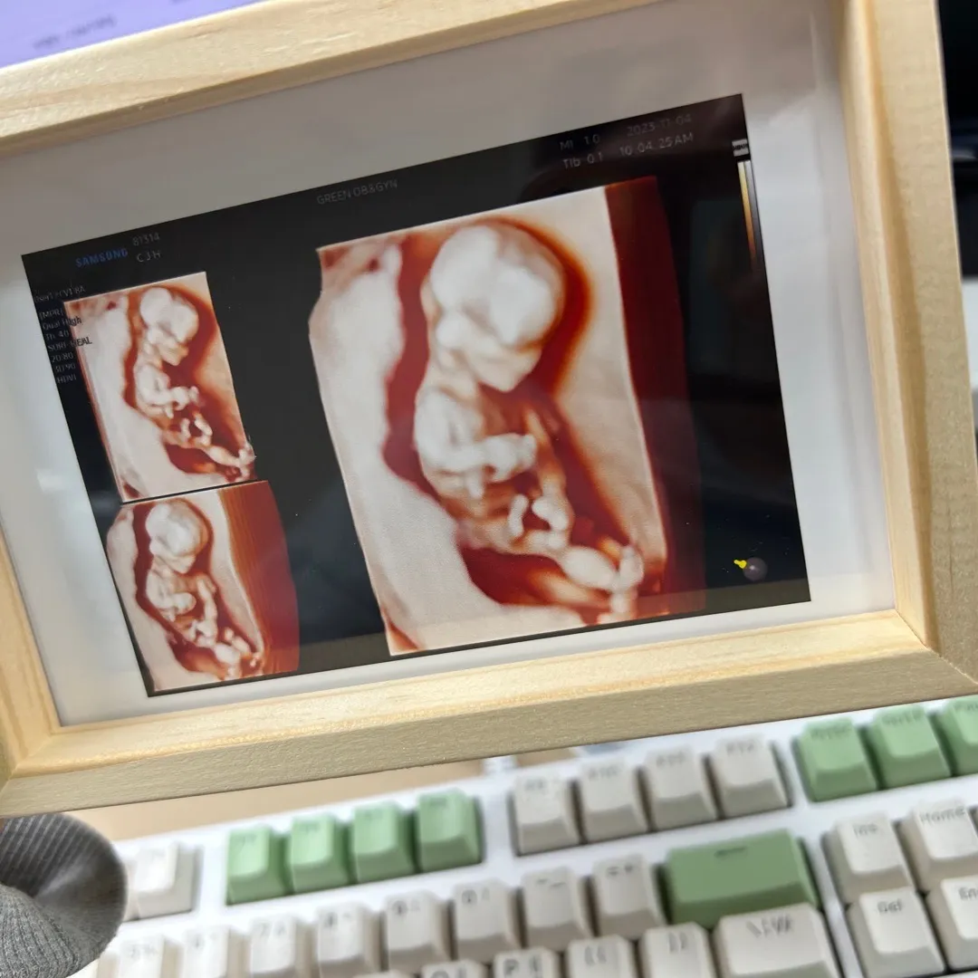 12주 1차 기형아 검사+ 첫 입체 초음파 👶🏻🤎