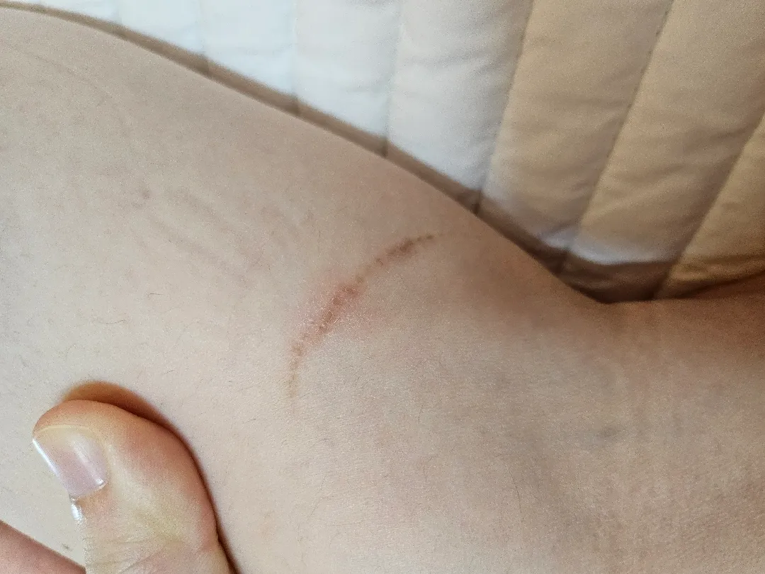 제왕 수술부위 외 다른 곳에 흉터가 생겼어요
