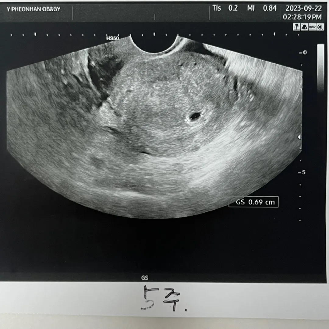5주1일 아기집 보고왔어요! 