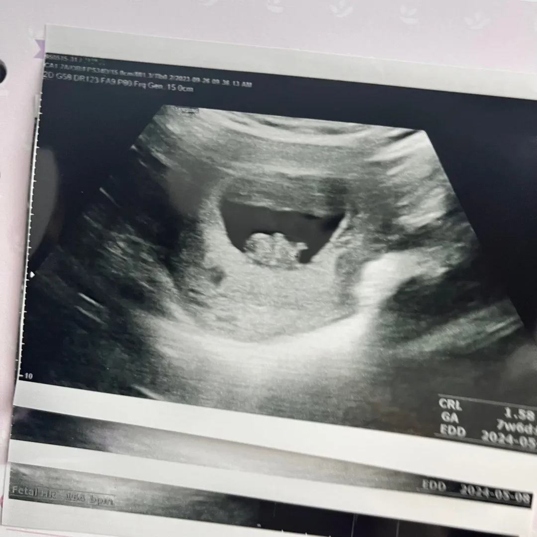 7주6일차 초음파