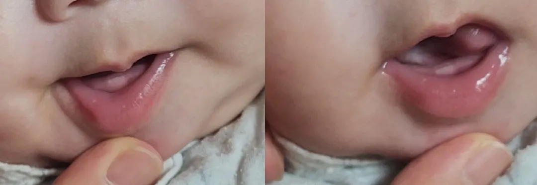 116일 아기인데 아랫니가 올라와써욤