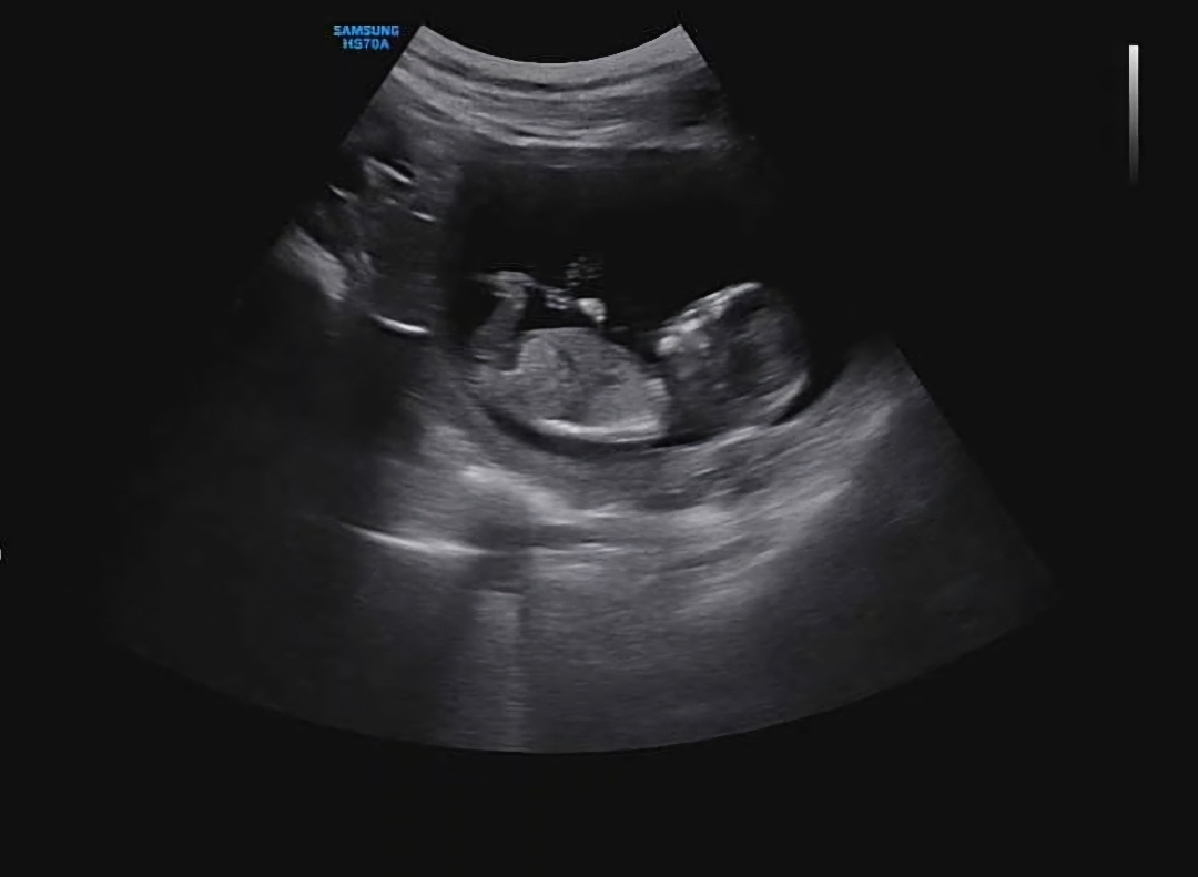 12주 3일..기대하지말라던데