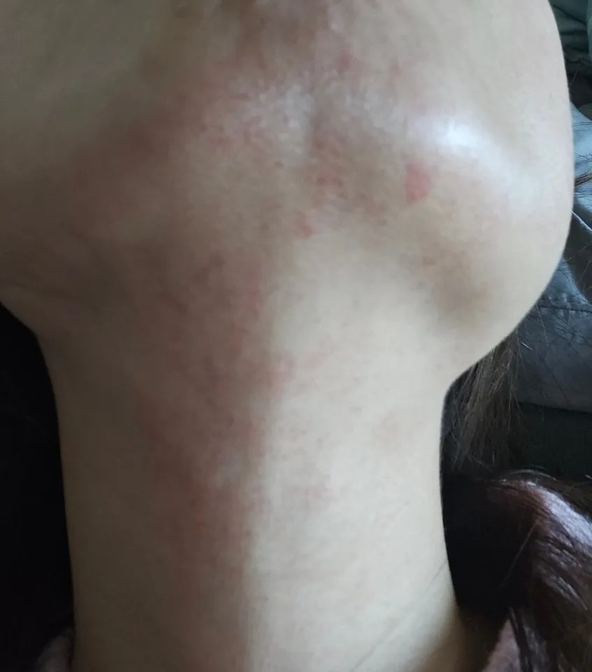 토하고 얼굴출혈..ㅠㅠ