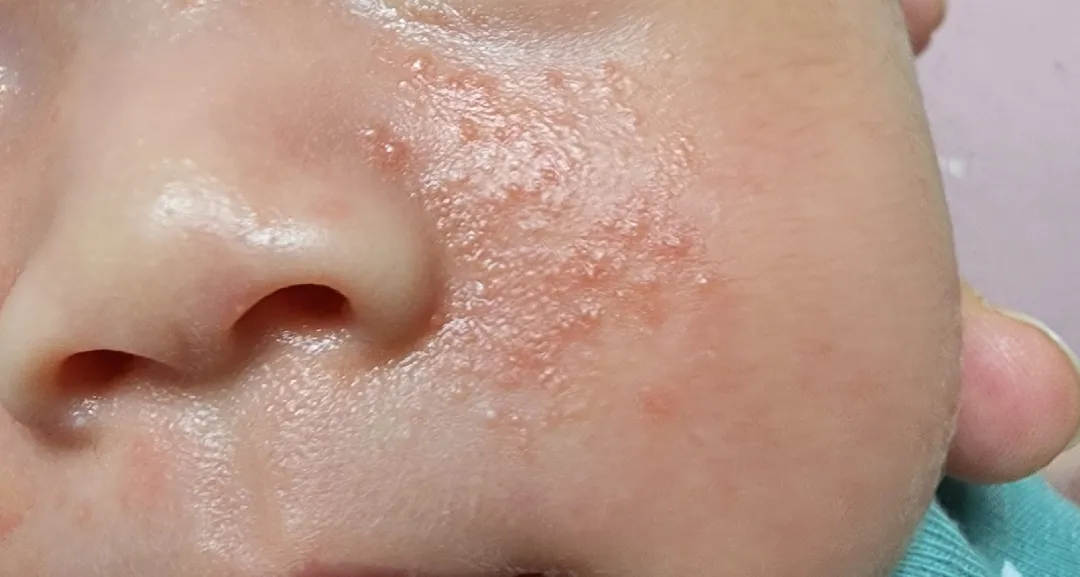 아기 태열 맞을까요??