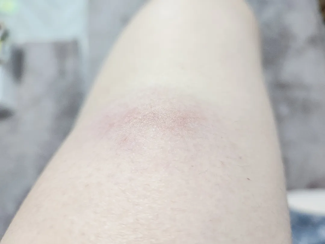 백일해 주사 맞으면 원래 이런가요?