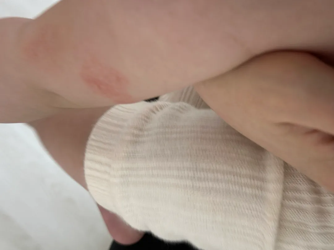 혹시 이거 아토피인가요? ㅠㅠ