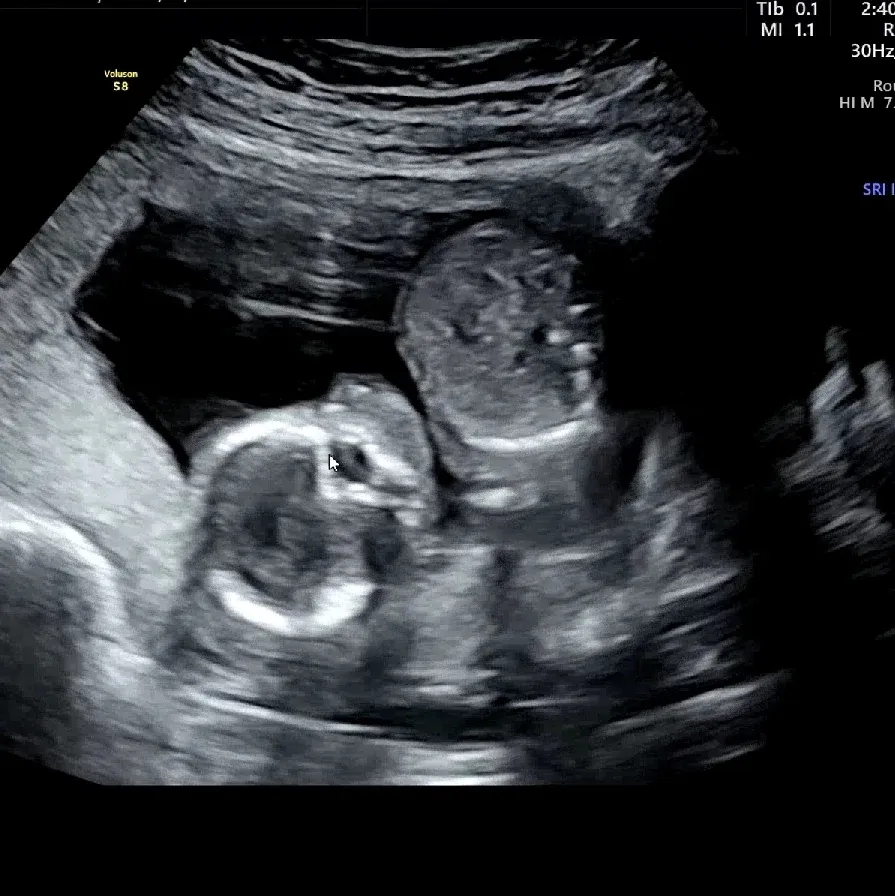 15주 6일 기형아 2차 + 성별 보고왔어요!!!