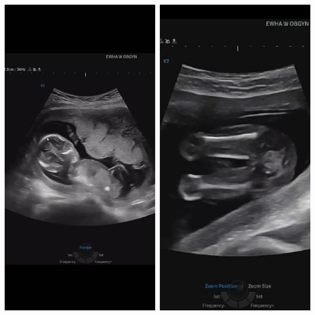 15주 6일 성별듣고왔어요!!❤️👶👀