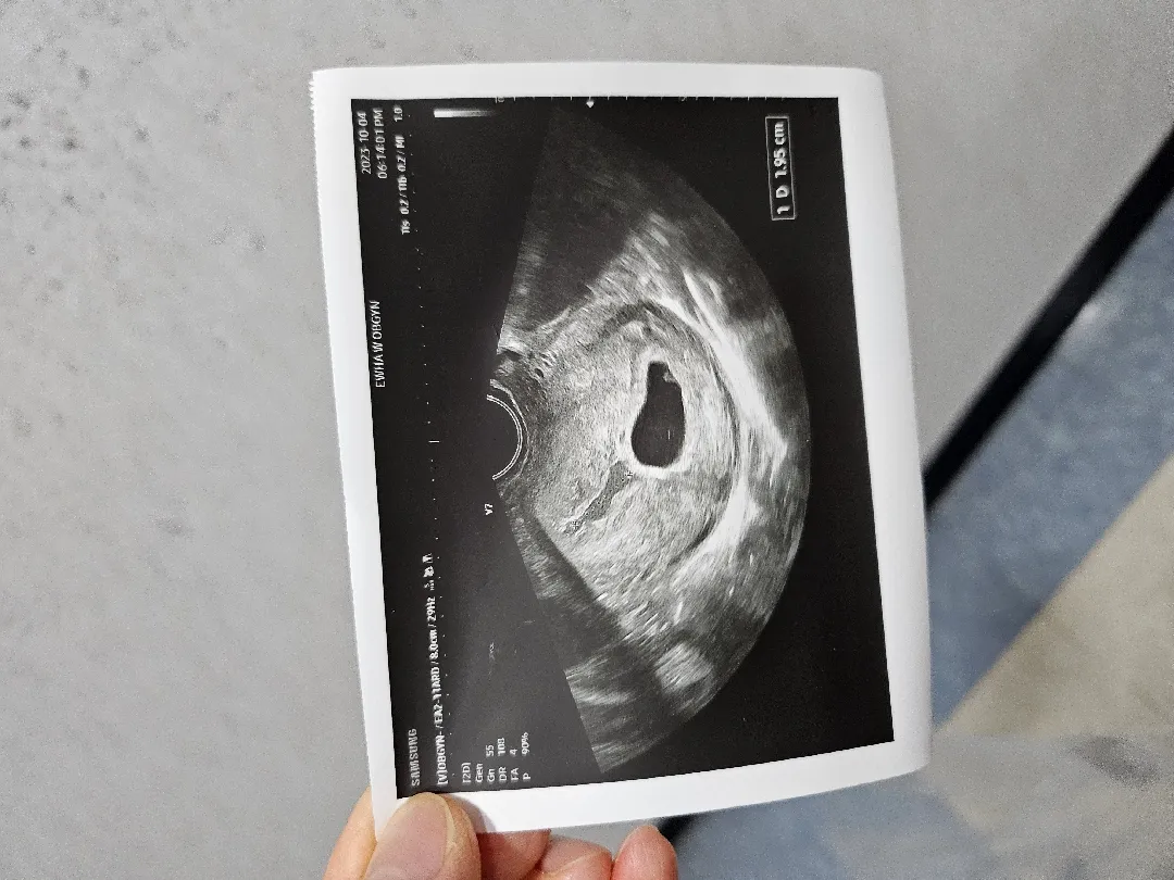 5주 6일 초음파👶