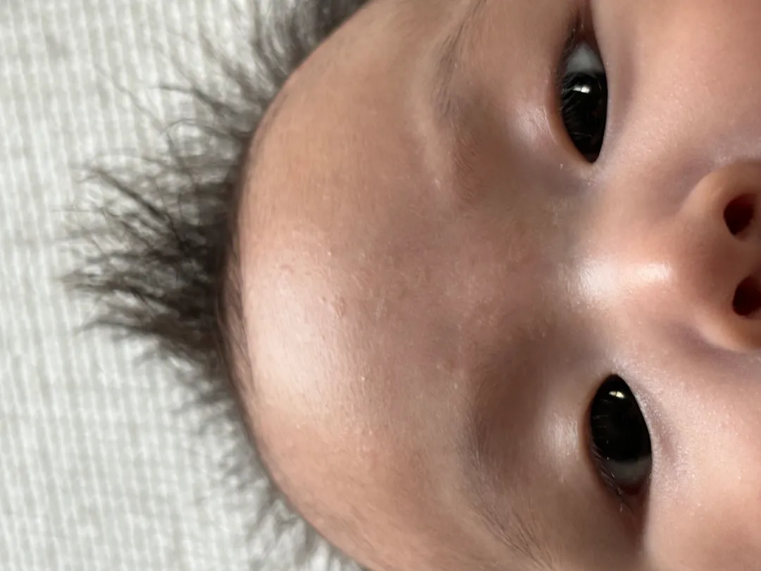100일 조금 넘은 아기 피부ㅜㅜ