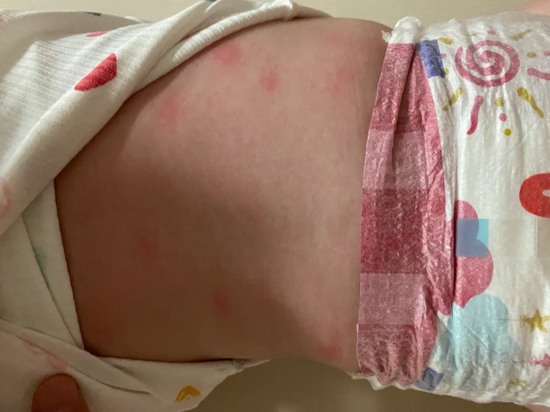 아기 등에 뭐가 났는데,, 뭐일까요?