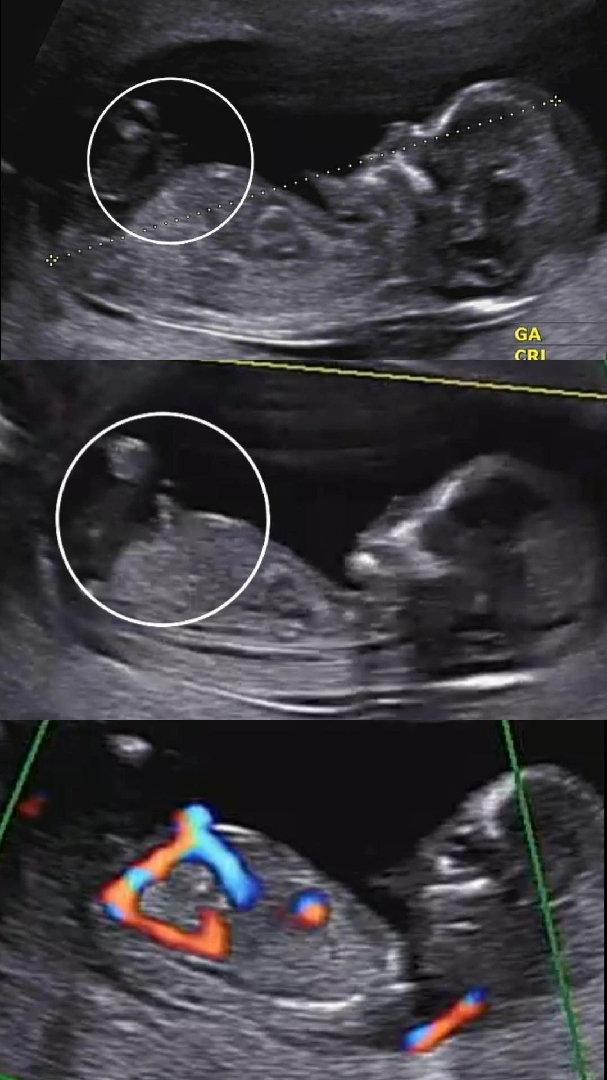 12주 초음파 각도법, 이것은 탯줄일까요!!