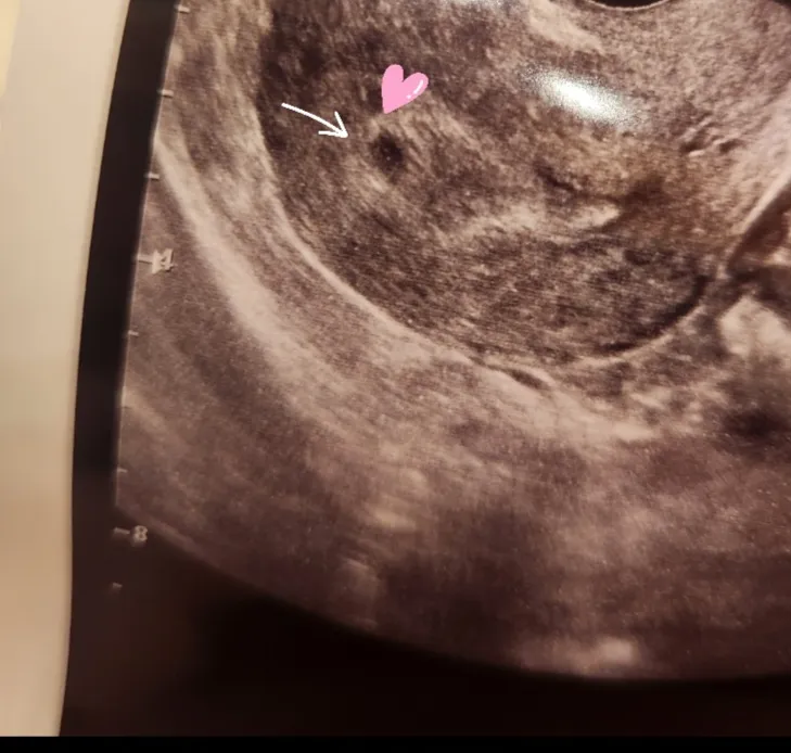 아기집 보고왔어요👶🏻