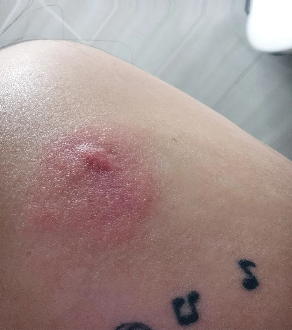 백일해접종 4일차