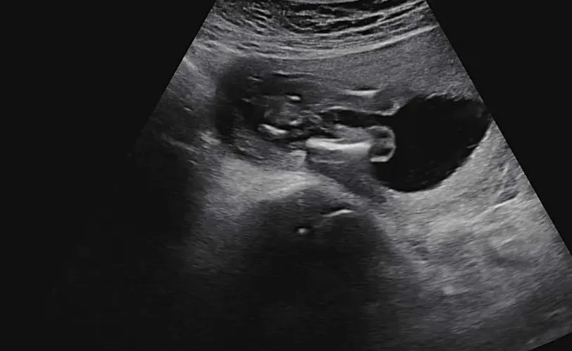 16주 5일처 성별 반전 케이스 높나요? 딸>아들.. 딸이라는데 맞겠죠!??